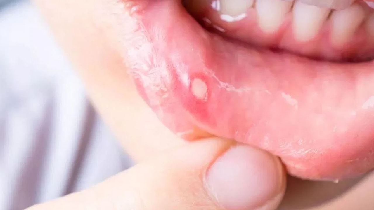 Soothe Canker Sores : మీ శరీరంలో అధిక వేడి వస్తే ఈ లక్షణాలు వస్తాయి.. ఈ చిట్కాతో నయం చేసుకోండి