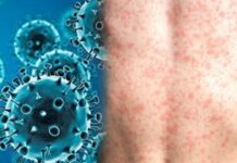 Mongolia’s measles spike: జాగ్రత్త! ఈ దేశంలో కరోనా లాంటి పరిస్థితి.. 10 వేలకు పైగా కేసులు.. Mongolias measles spike