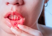 Mouth Ulcers Causes: నోటి పూతలు ఇబ్బంది పెడుతున్నాయా? ఇలా చేయండి. Mouth-Ulcers