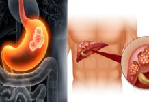 Reasons behind Cancer: 2008 నుంచి 2017 మధ్య పుట్టిన వారికి క్యాన్సర్. ప్రమాదంలో 1.56 కోట్ల మంది. కచ్చితంగా చదవాల్సిన అధ్యయనం Reasons behind Cancer