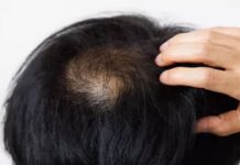 Hair Growth: మాయ లేదు.. మంత్రమూ లేదు.. బట్టతలపై జుట్టు.. ఎలా సాధ్యమంటే? Hair Growth