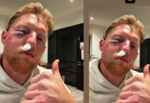 Ben Stokes Injury Update: కన్ను లొట్ట పోయింది.. మూతి వాచింది.. బెన్ స్టోక్స్ కు ఏమైంది? Ben Stokes Injury Update