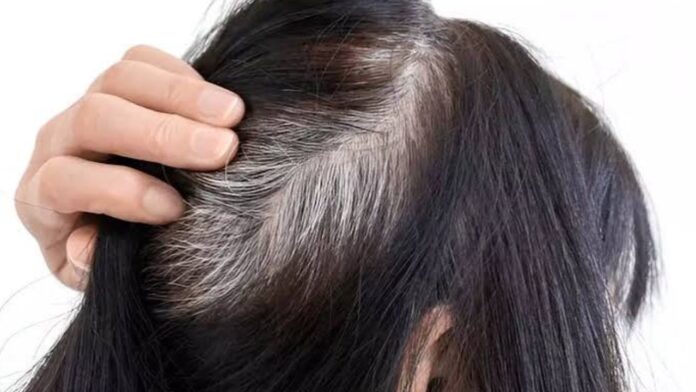 Premature Grey Hair